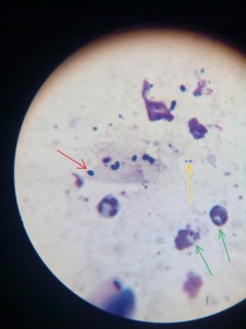 Smíšená otitida (červená šipka: kvasinky, oranžová šipka: bakterie, zelená šipka: bílé krvinky pohlcující bakterie).